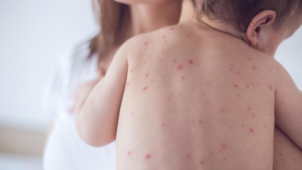Virginia health officials warn of possible measles exposure - WSET thumbnail