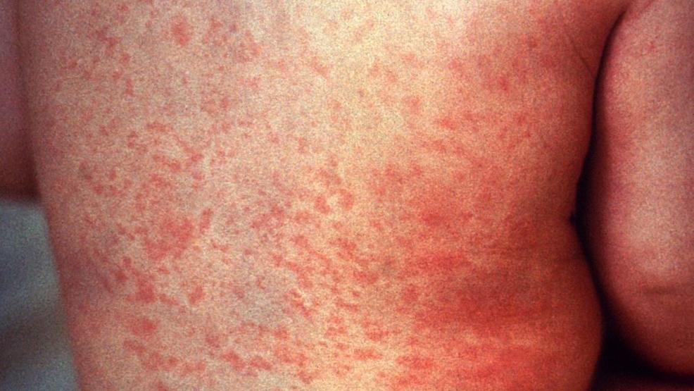 TN Health Dept: First Case Of Measles Detected In Tennessee As Part Of ...